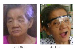 Affordable Cataract Surgery with Philhealth